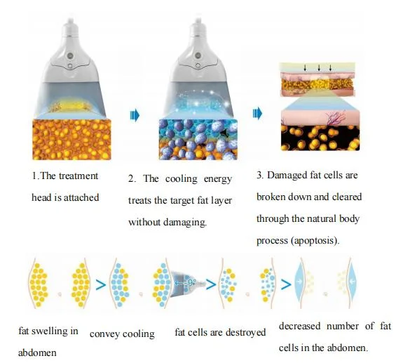 New 360 Cryotherapy Cellulite Removal Cryolipolisis Body Slimming Vacuum Cryolipolysis Machine