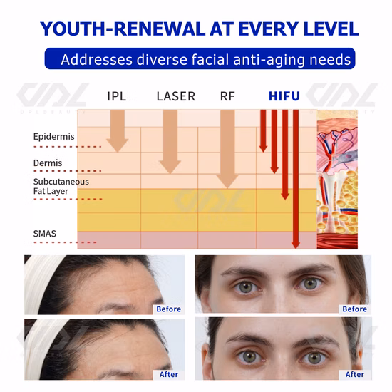 5D 7D Картриджи Hifu 12 линий Подтяжка лица Портативный Vmax Hifu Вагинальная подтяжка тела для похудения 4D Hifu